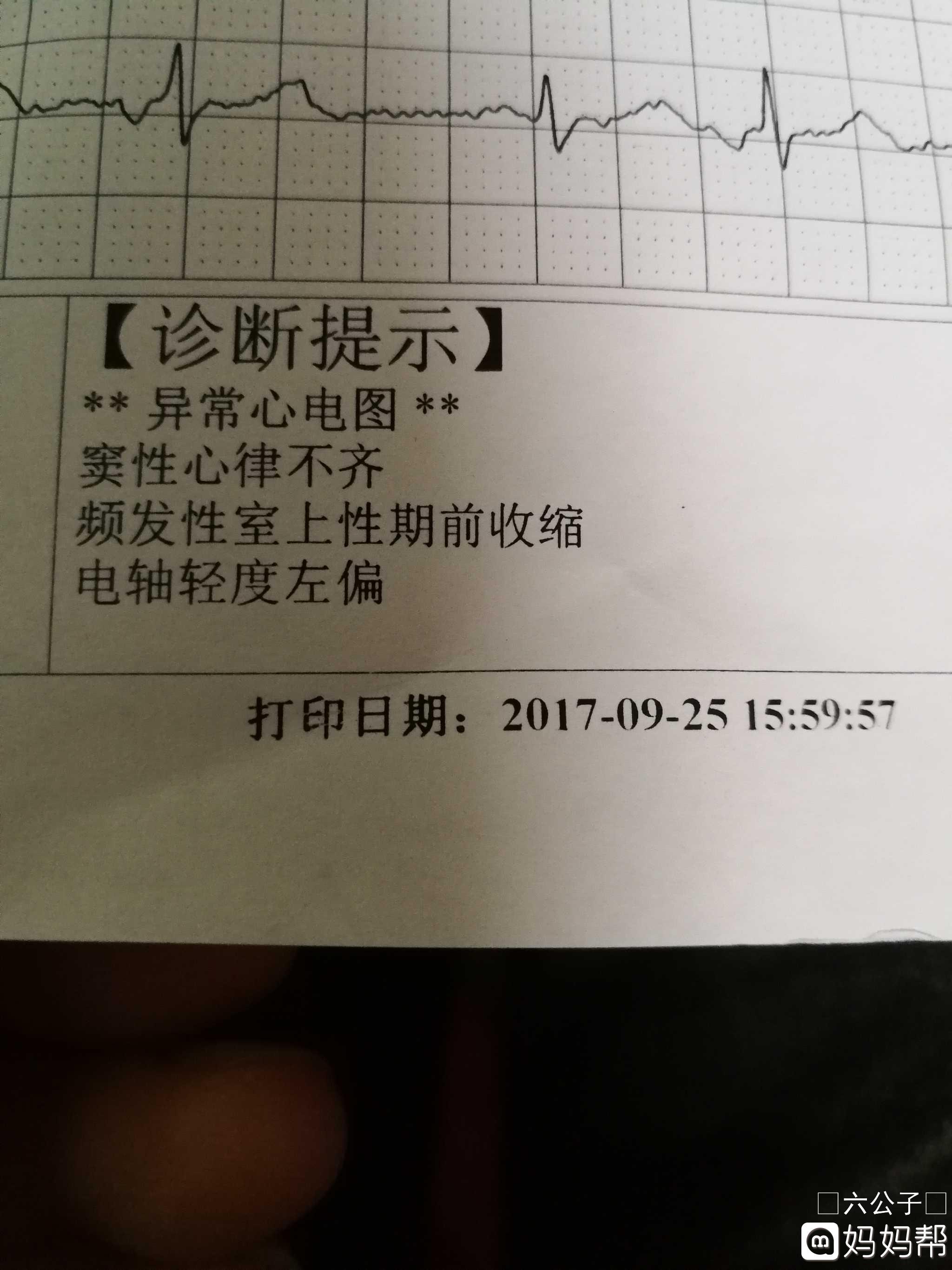 香港验血空腹抽血会有影响吗_空腹做心电图有影响吗_做心梗造影前吃饭了有唅影响