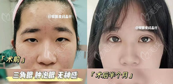做双眼皮的坏处_做双眼皮价格介绍_杭州整形做双眼皮的