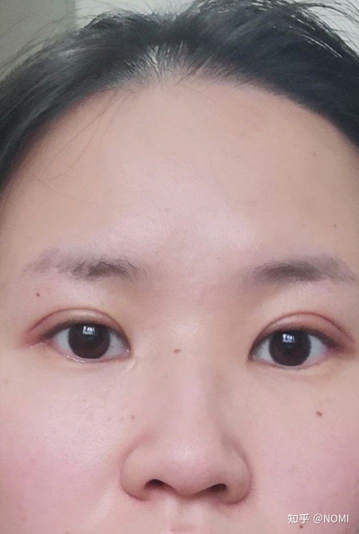 做双眼皮价格介绍_杭州整形做双眼皮的_做双眼皮的坏处