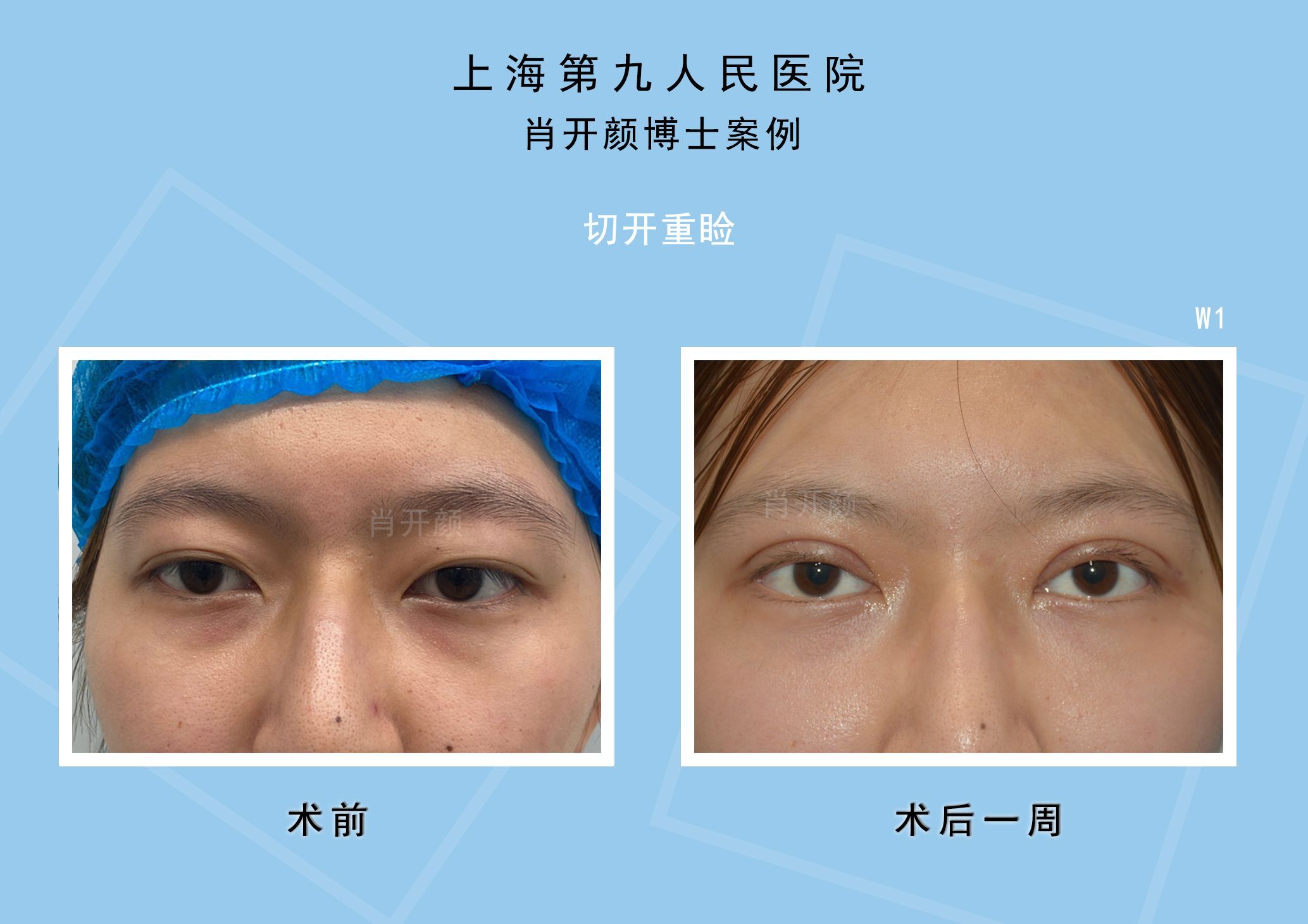 做双眼皮价格介绍_做双眼皮的危害_蟾蜍皮价格,干蟾皮价格