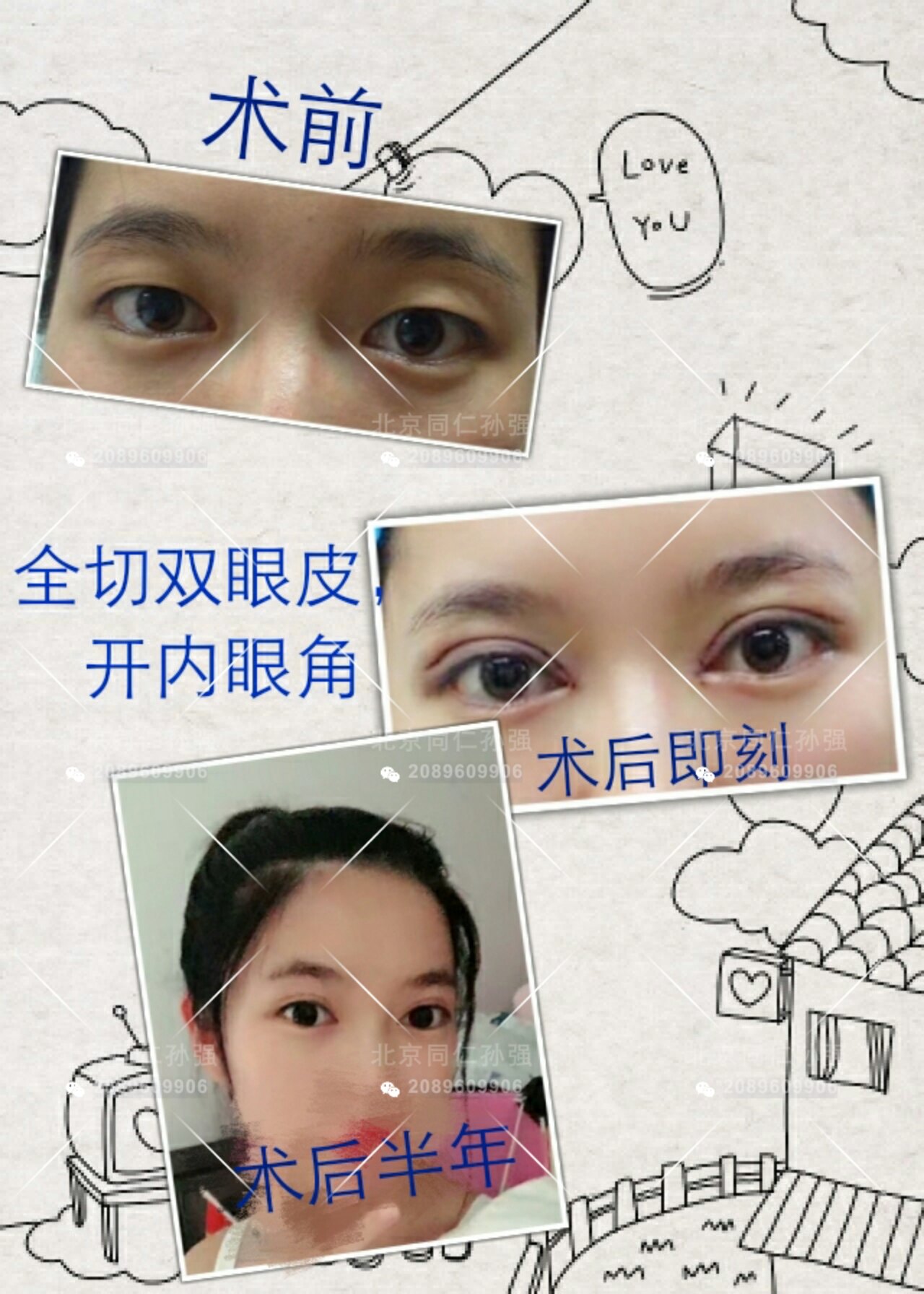做双眼皮价格介绍_蟾蜍皮价格,干蟾皮价格_做双眼皮的危害