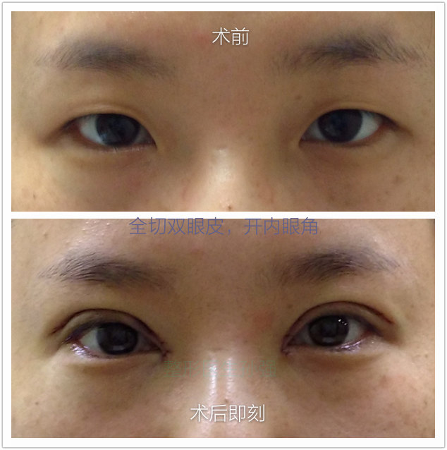 献血后需要注意哪些事项?_做好双眼皮后注意事项_药水点痣后需要注意什么事项