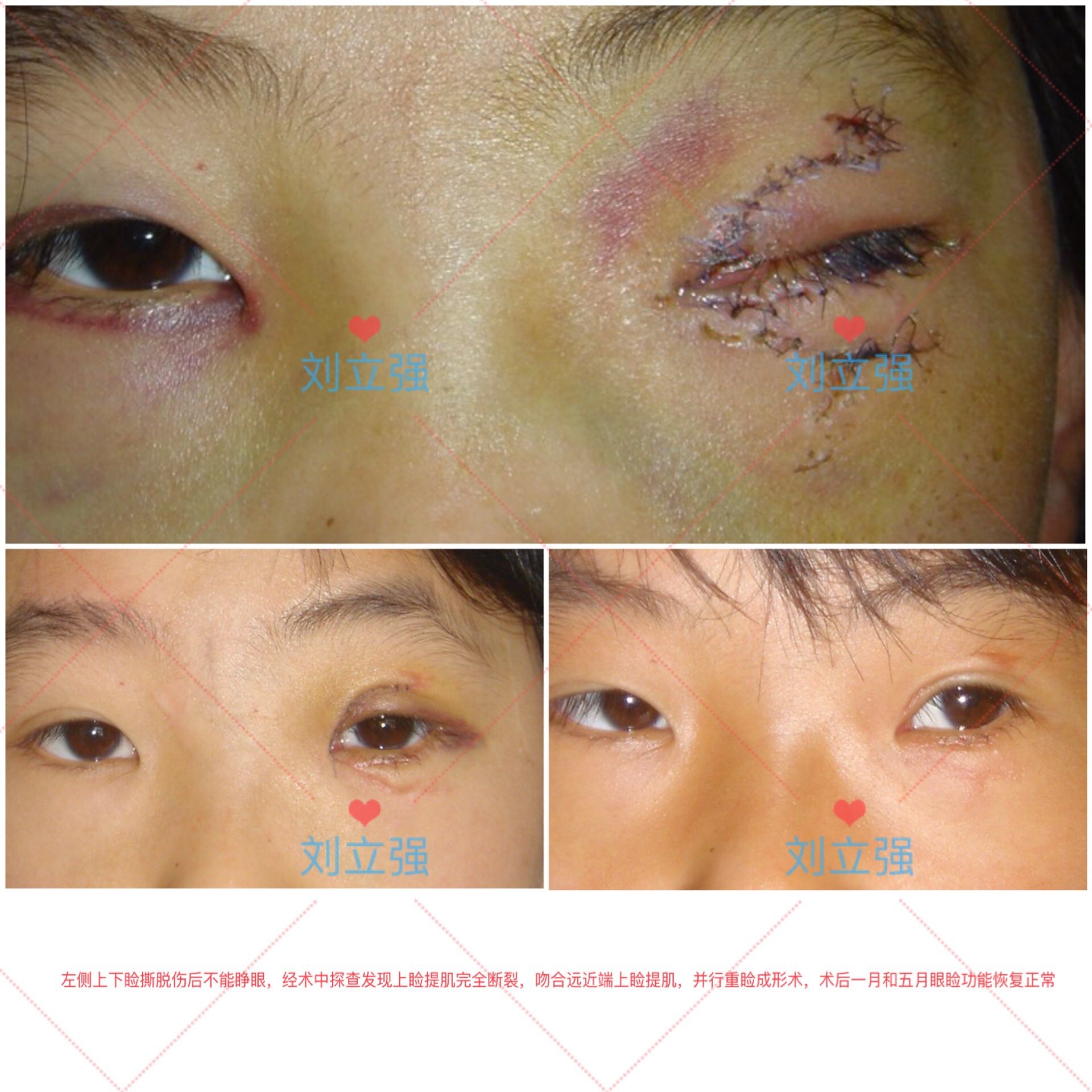 献血后需要注意哪些事项?_药水点痣后需要注意什么事项_做好双眼皮后注意事项