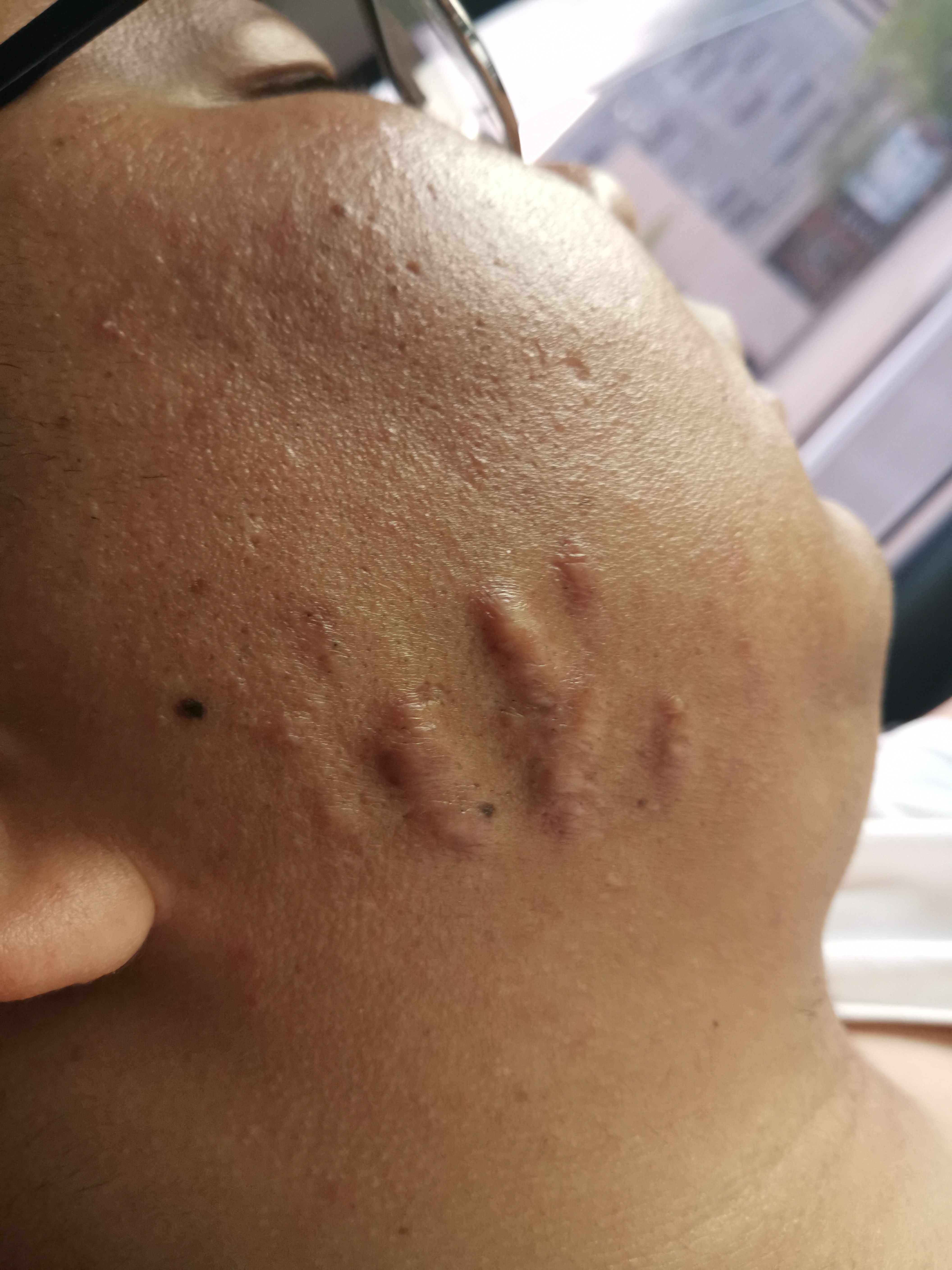 2度烫伤黑色素几年能退_100度热水烫伤手_2度烫伤会留疤吗
