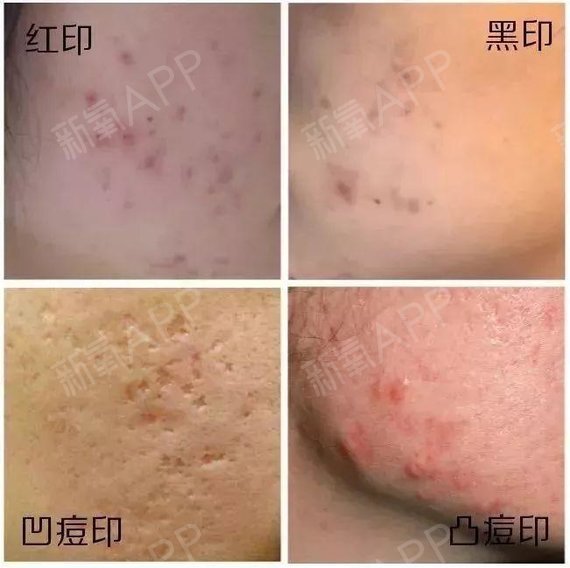 100度热水烫伤手_2度烫伤会留疤吗_2度烫伤黑色素几年能退