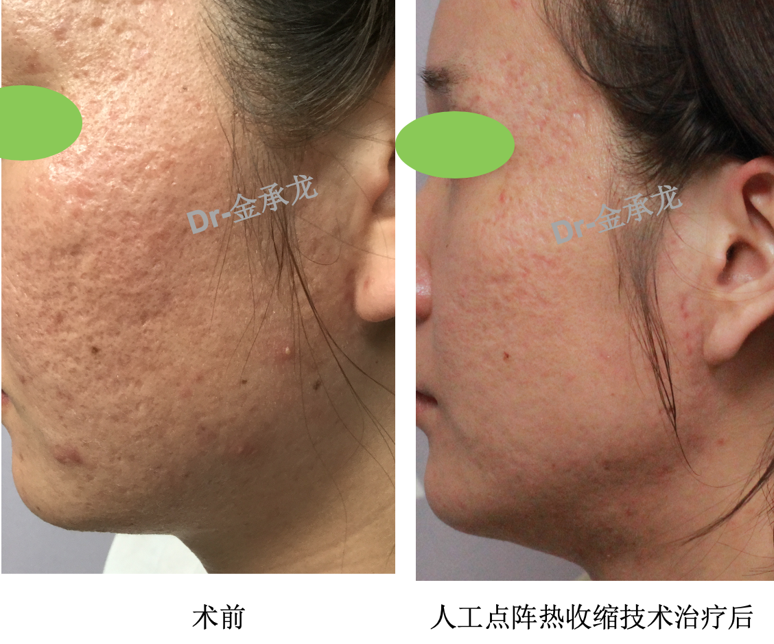 2度烫伤会留疤吗_100度热水烫伤手_2度烫伤黑色素几年能退