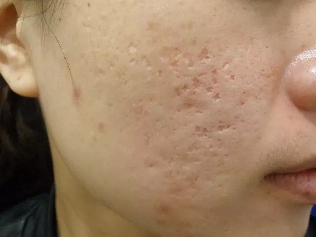 2度烫伤会留疤吗_2度烫伤黑色素几年能退_100度热水烫伤手