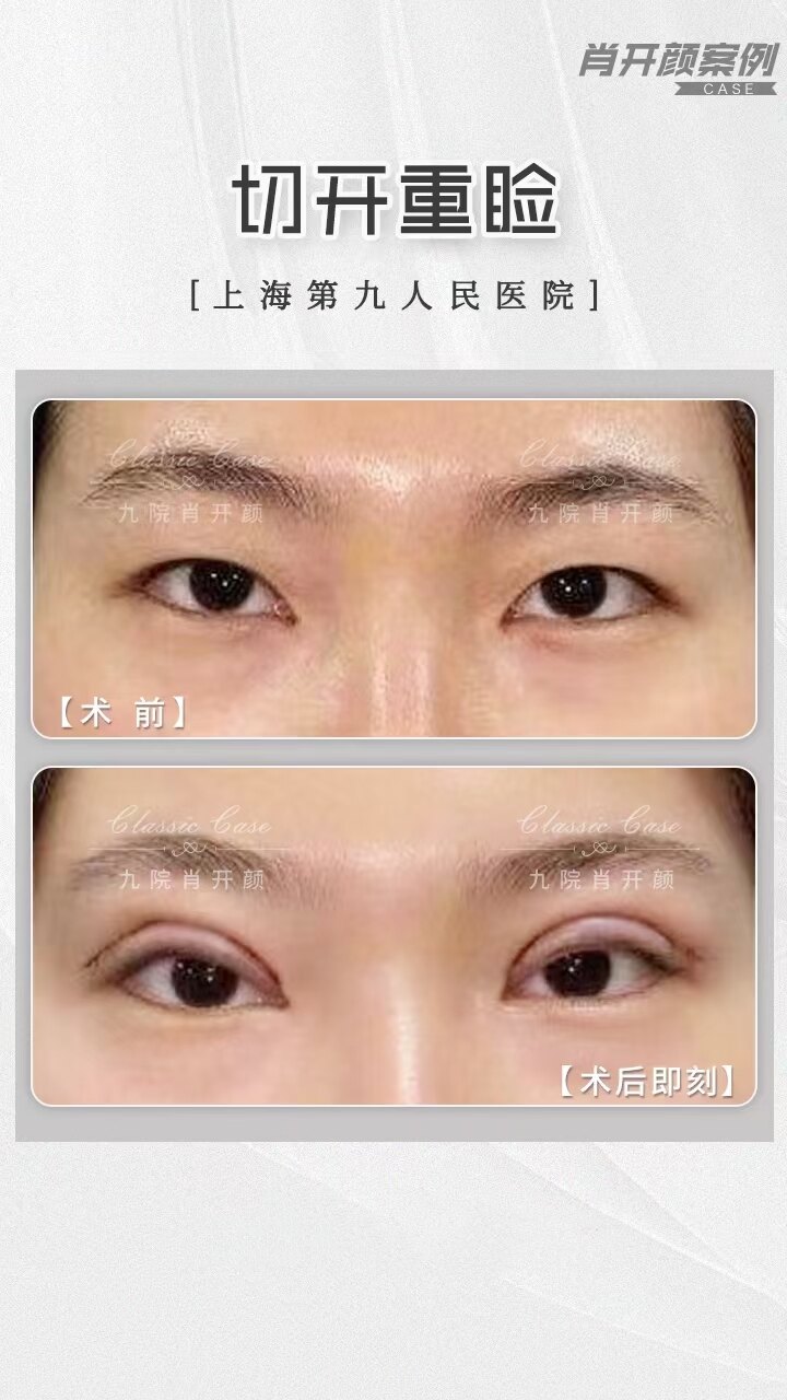 食用胶做皮冻视频_高分子做双眼皮视频_马桶疏通皮撅子视频