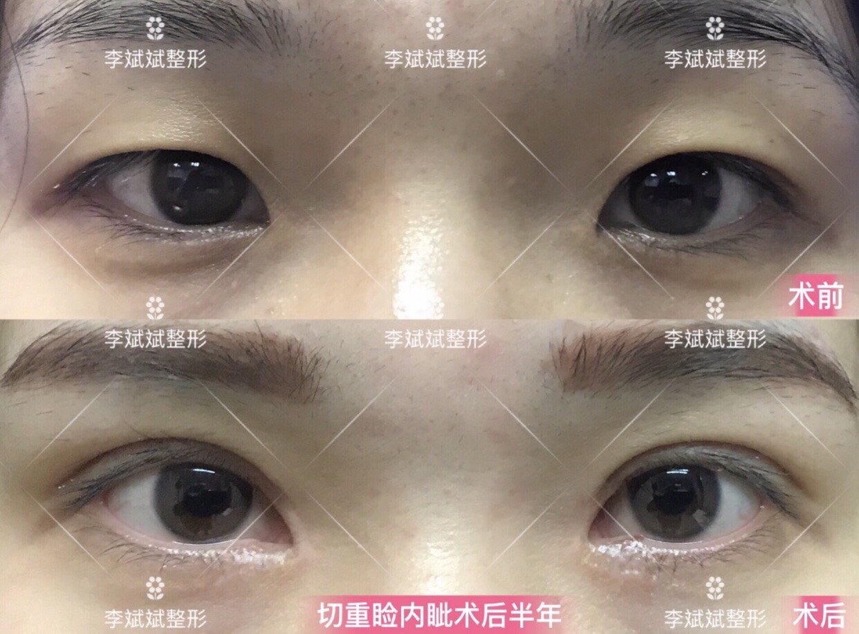 马桶疏通皮撅子视频_食用胶做皮冻视频_高分子做双眼皮视频