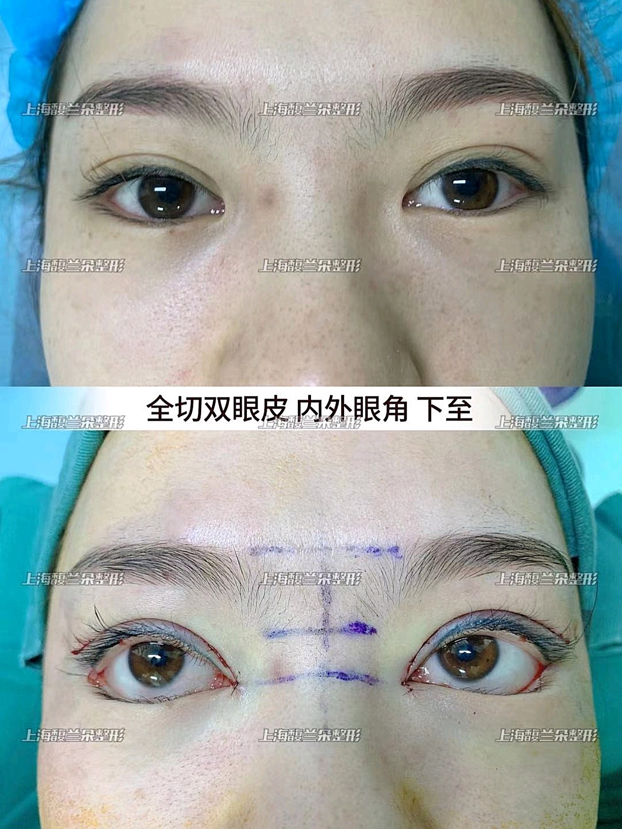 马桶疏通皮撅子视频_高分子做双眼皮视频_食用胶做皮冻视频