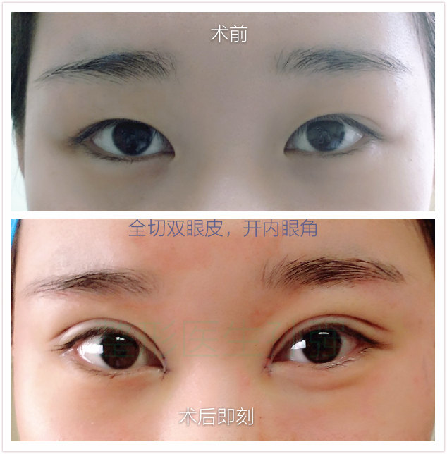 马桶疏通皮撅子视频_高分子做双眼皮视频_食用胶做皮冻视频