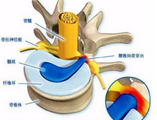 健康之路腰椎间盘突出_腰椎健盘突出怎么治疗_腰椎肩盘突出素