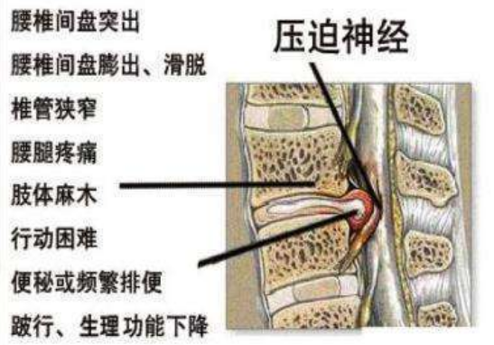 腰椎尖盘突出看哪个科_治疗腰椎肩盘突出医院_健康之路腰椎间盘突出