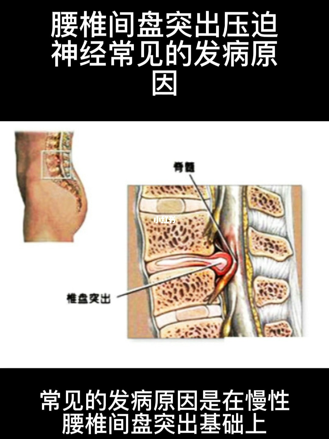 健康之路腰椎间盘突出_治疗腰椎肩盘突出医院_腰椎尖盘突出看哪个科