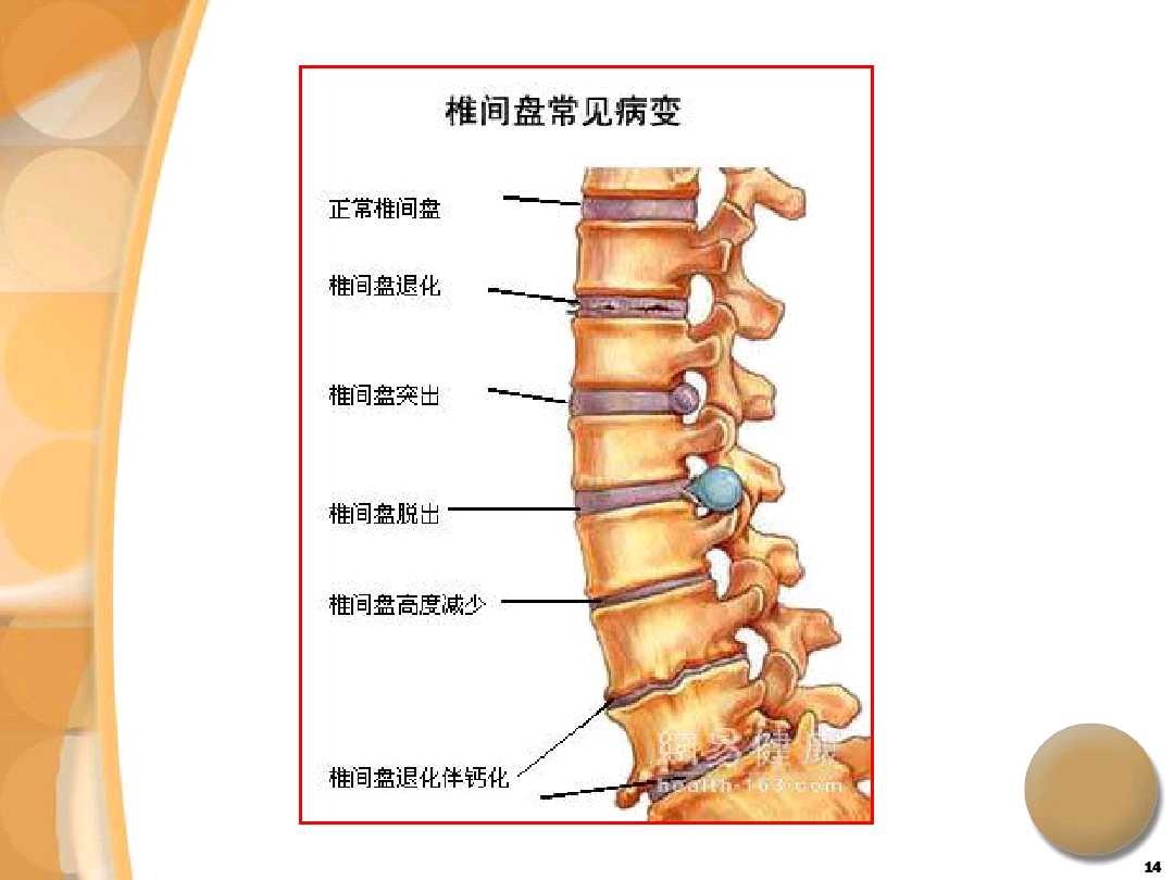 腰椎尖盘突出看哪个科_治疗腰椎肩盘突出医院_健康之路腰椎间盘突出