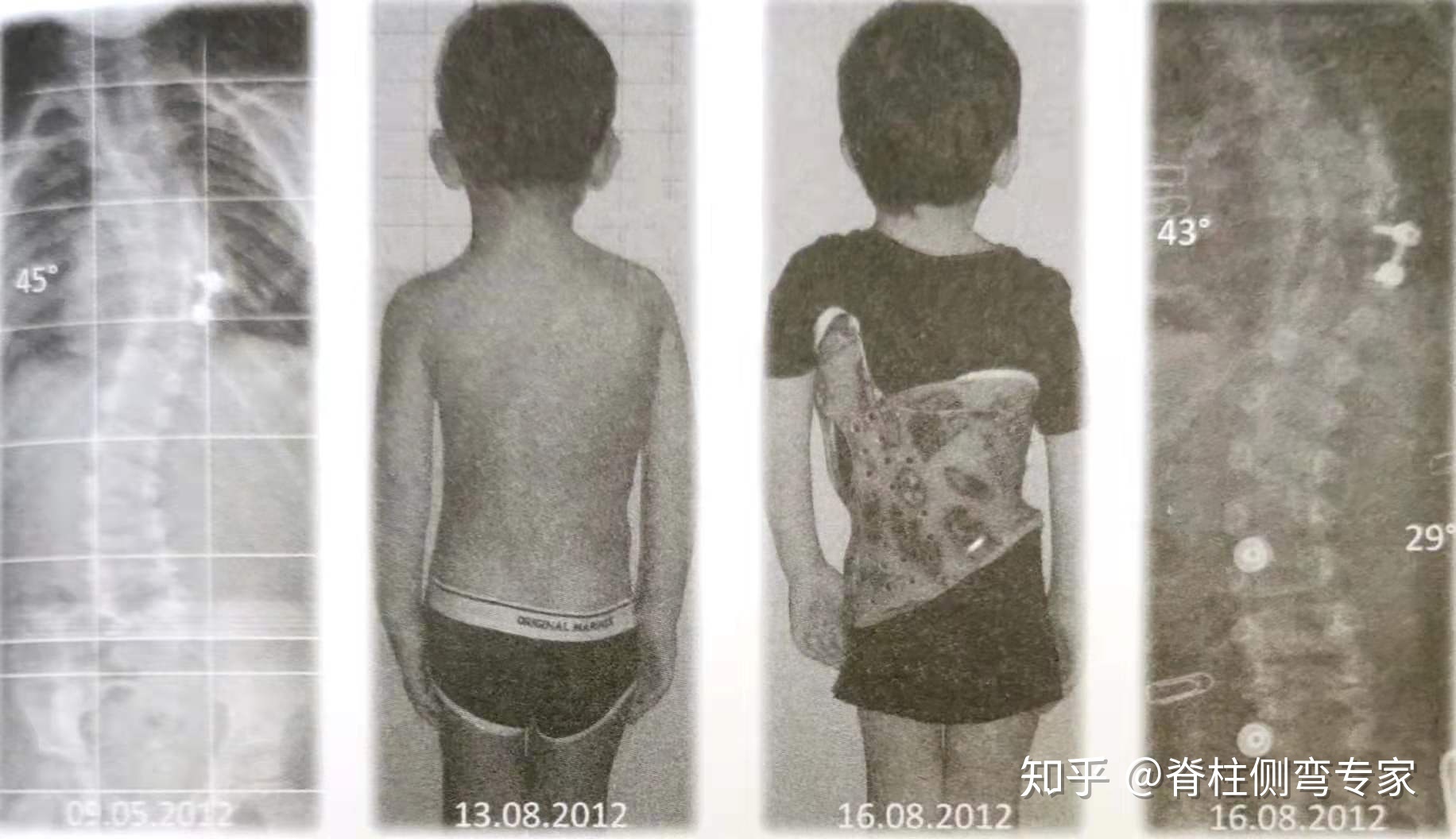 脊柱侧弯断棒有多疼_断奶奶 涨疼有硬块怎么办_脊柱生理弯曲的意义