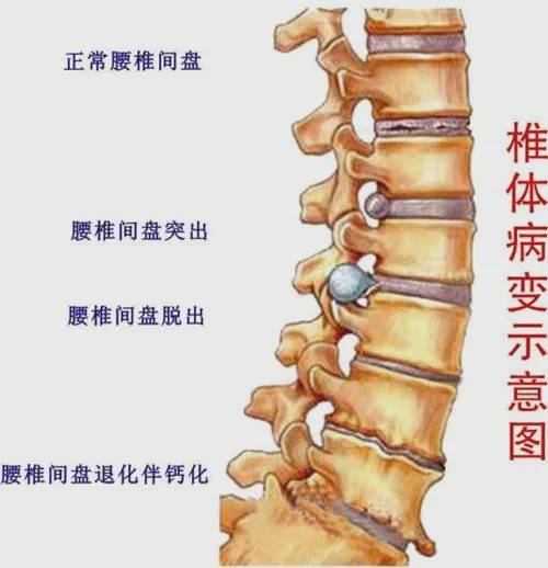 颈椎间盘突出的锻炼_颈椎盘突出早期症状_深圳治疗颈椎盘突出
