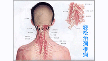 颈椎盘突出能治好吗_颈椎间盘突出的锻炼_怎样治疗颈椎盘突出