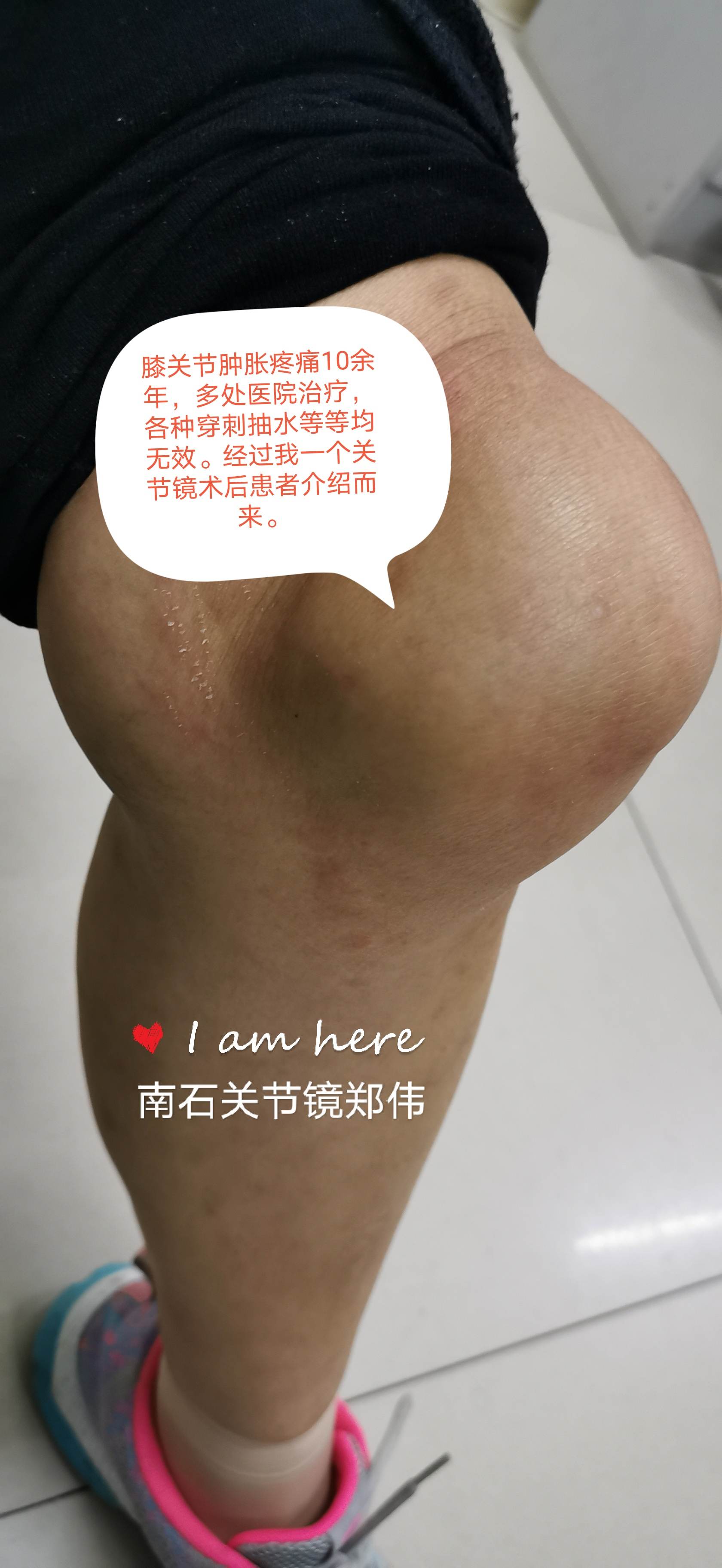 练蜜桃臀腿会粗吗_金鸡独立会不会把腿练粗_练蹲起会不会腿粗