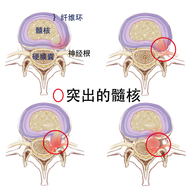 腰椎肩盘突出压迫神经_得了腰椎间盘突出 英文_腰椎尖盘突出症的治疗