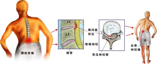 腰椎滑脱的锻炼图片_腰椎间盘怎么锻炼图片_腰椎锻炼恢复强直性脊柱炎图片