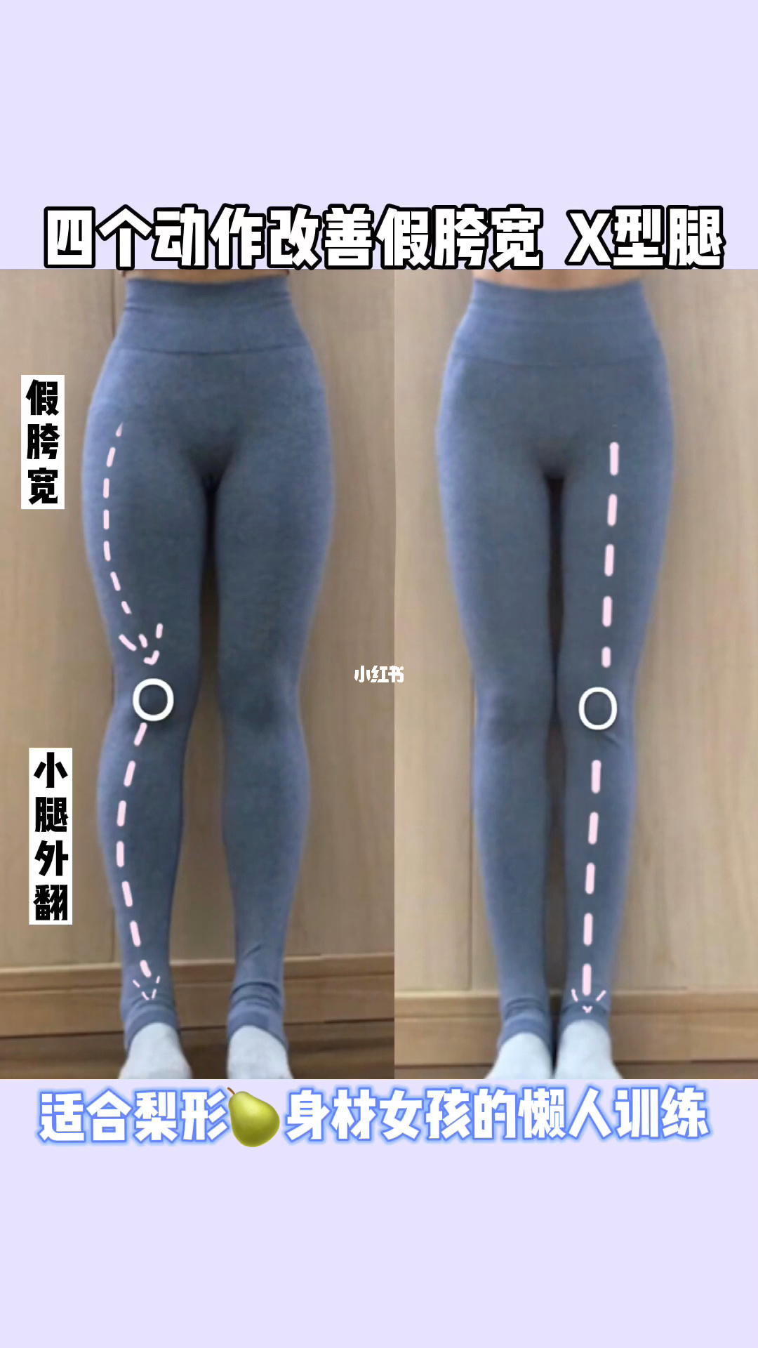 半个月矫正假胯宽_假胯宽是能矫正过来吗_吸脂可以矫正假胯宽