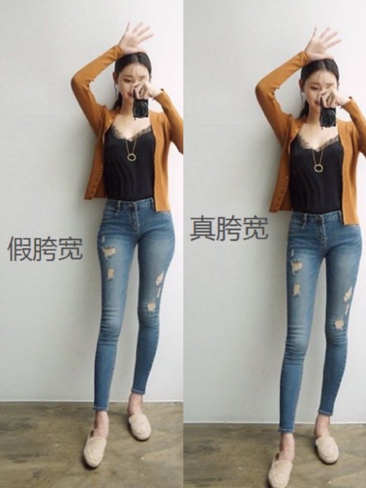 半个月矫正假胯宽_假胯宽是能矫正过来吗_吸脂可以矫正假胯宽