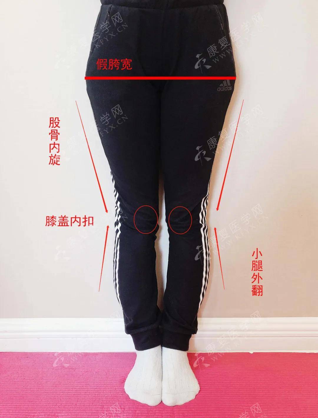 假胯宽是能矫正过来吗_假胯宽睡觉怎么矫正_假胯宽是能矫正过来吗