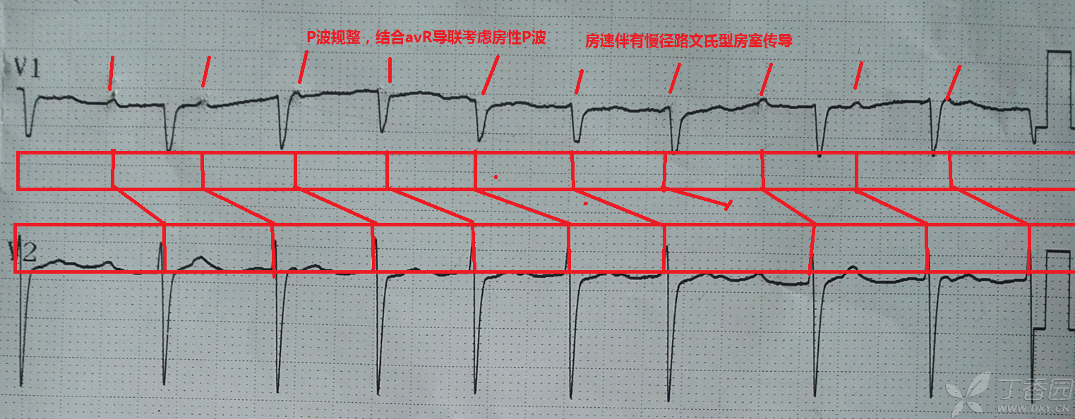 房性心动过速心电图特点_折返性房性心动过速_交响性百万亚瑟王心动