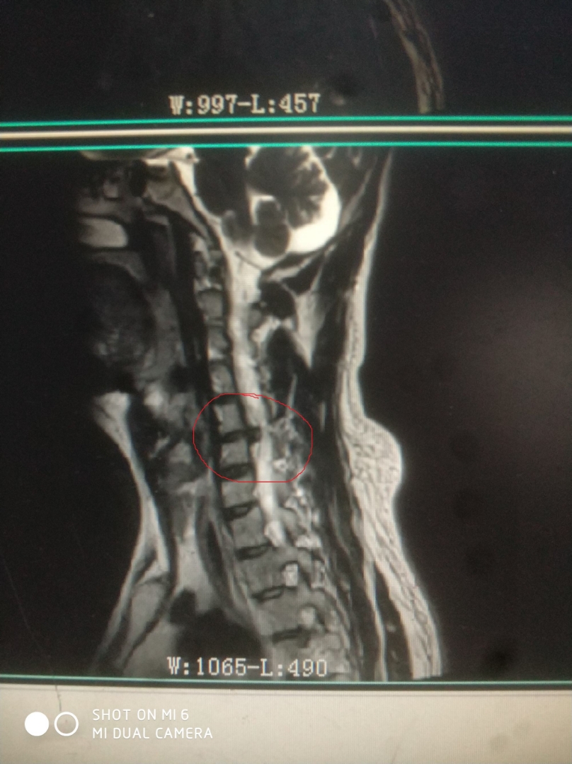 如何预防腰间椎盘突出_腰间盘突出缓解锻炼法_腰间椎盘突出怎么调理