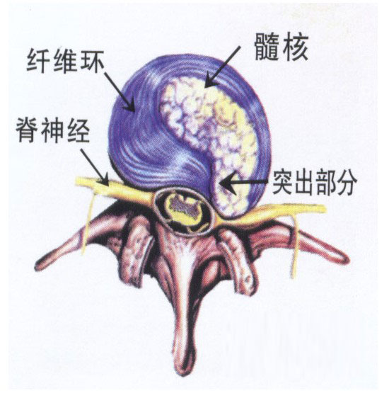 腰间椎盘突出怎么调理_腰间盘突出缓解锻炼法_如何预防腰间椎盘突出