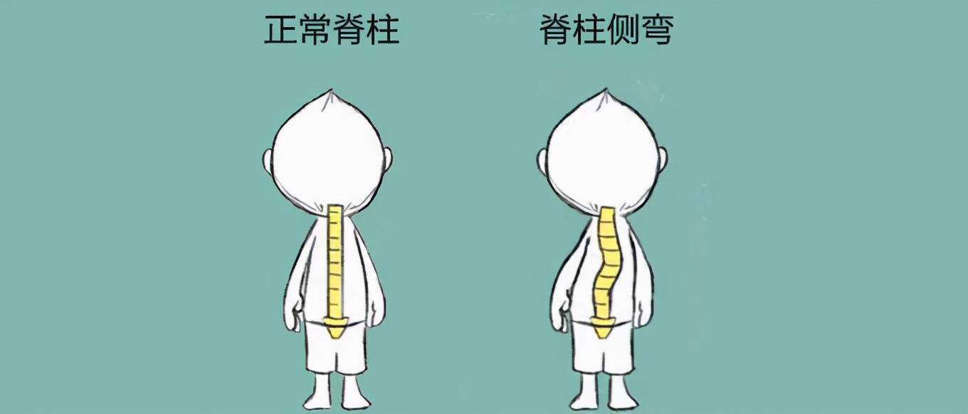 脊柱侧弯不能做的运动_后背脊柱往后弯腰疼_做拉伸运动真的能长高吗