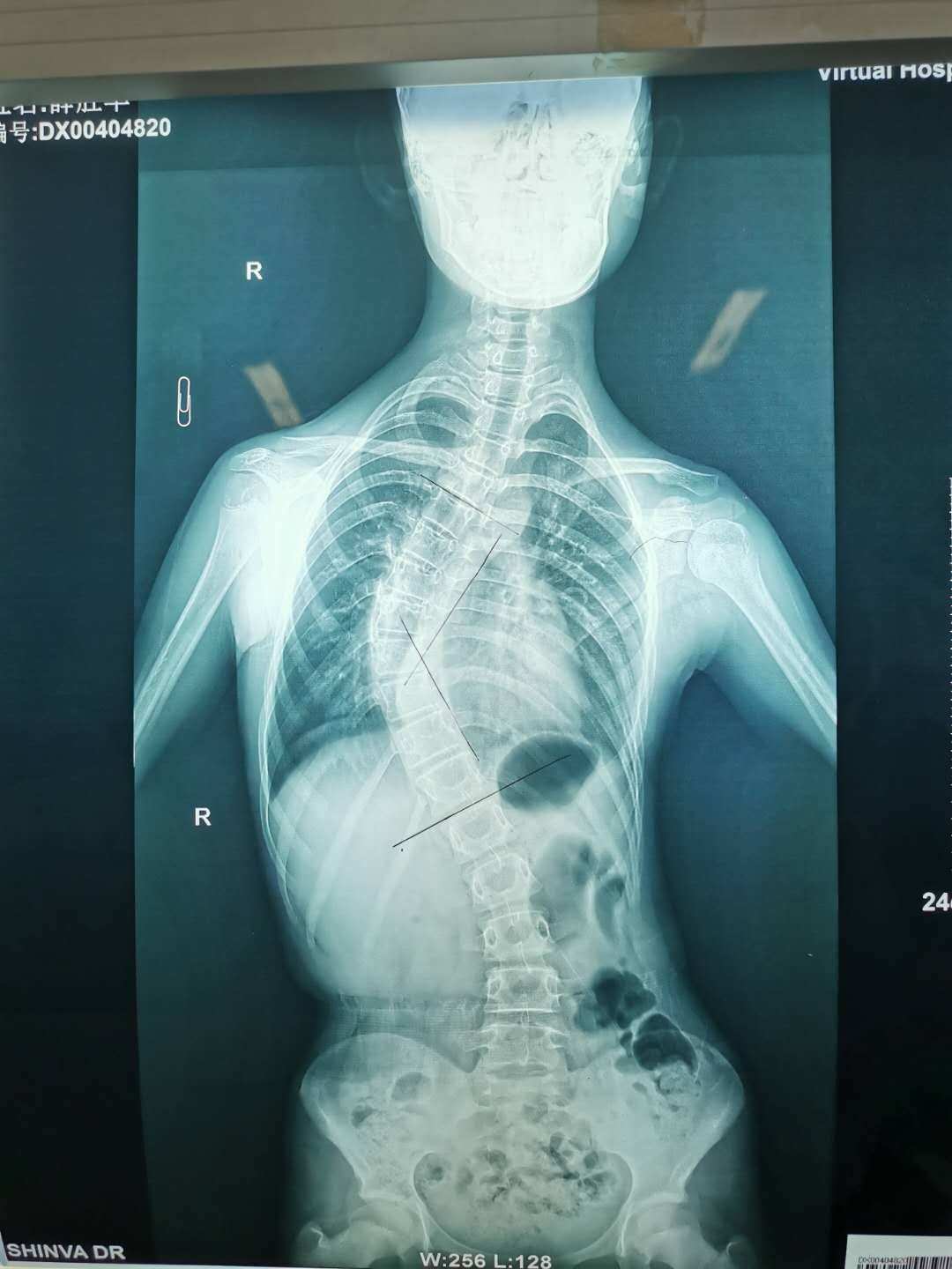 腰部脊柱弯腰疼_脊柱侧弯不能做的运动_做运动能治好声带息肉吗