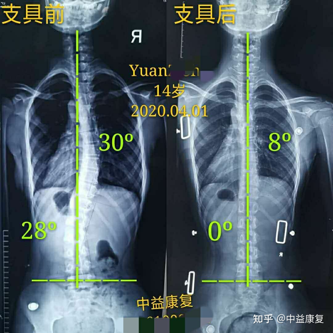 腰部脊柱弯腰疼_脊柱侧弯不能做的运动_做运动能治好声带息肉吗