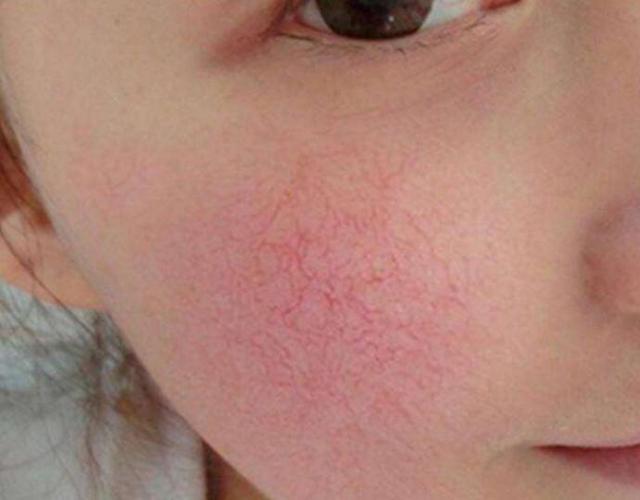 眼睛红有血丝怎么回事_宝宝腿缝红有水泡怎么回事_腿上有红血丝可以散步跑步