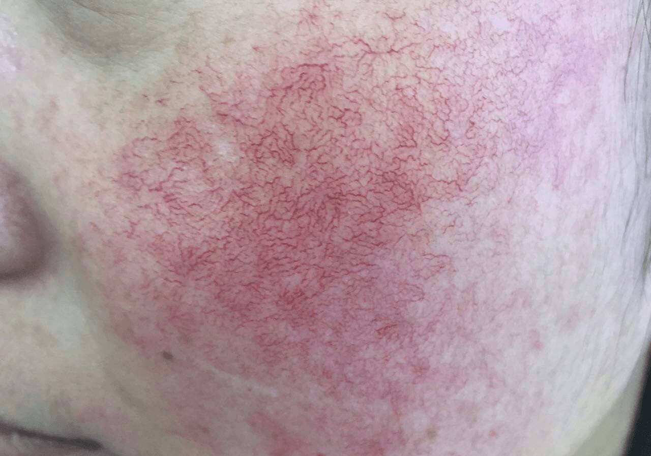宝宝腿缝红有水泡怎么回事_眼睛红有血丝怎么回事_腿上有红血丝可以散步跑步