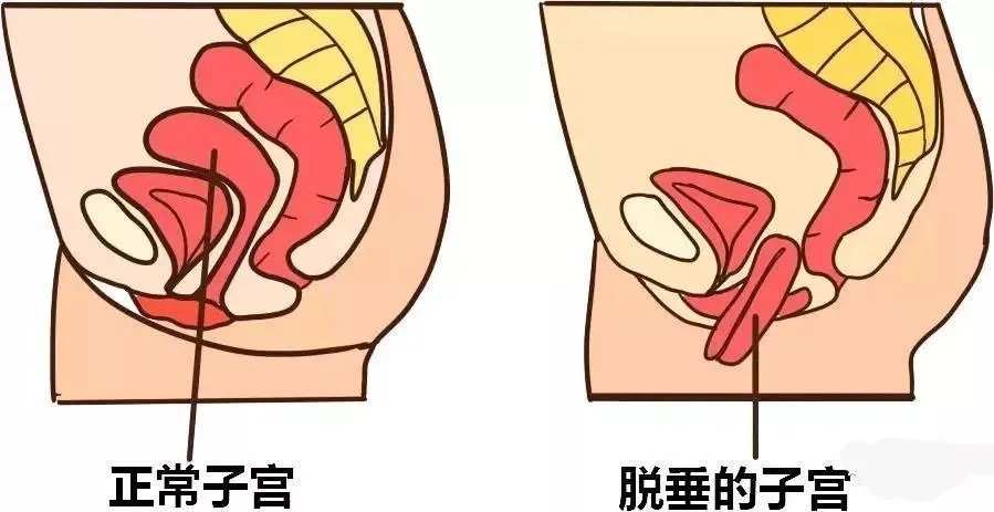 盆底肌训练_凯格尔盆底肌训练什么时候做_训练骨盆底肌的好处