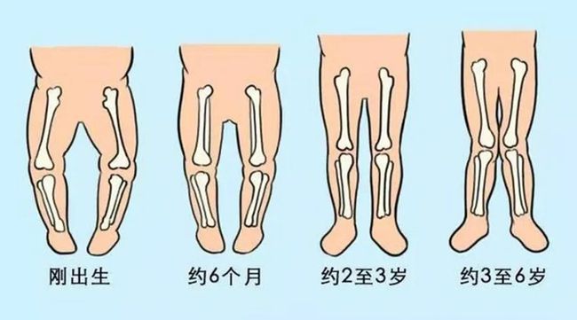 盘腿坐能矫正x型腿吗_怎样矫正x腿型_x腿型矫正带