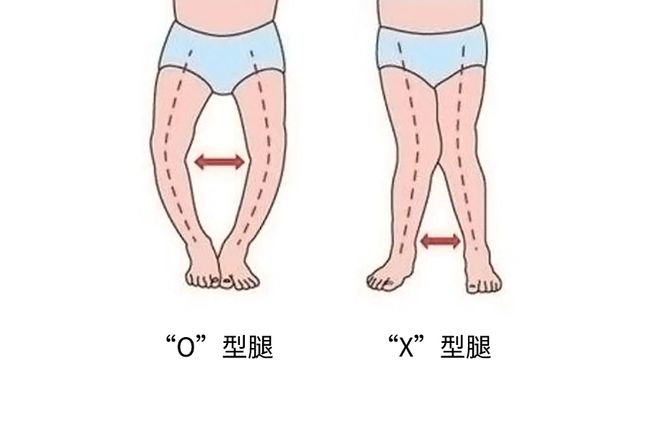 矫正x腿型5个瑜伽动作_如何改善腿型,让腿变直_改善x型腿的瑜伽