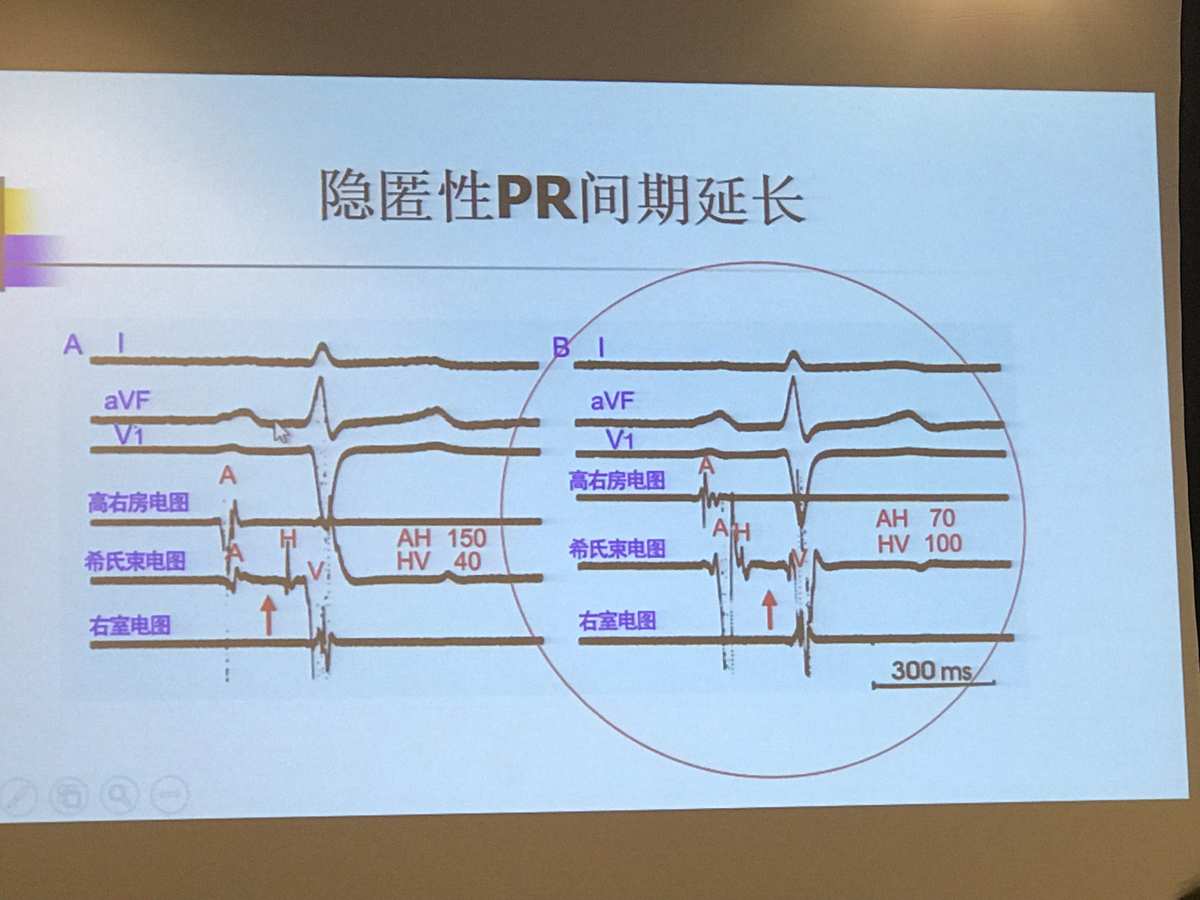 非特异性t波改变是心肌缺血吗_q波异常改变_心电图q波改变原因